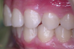 Après le traitement orthodontique