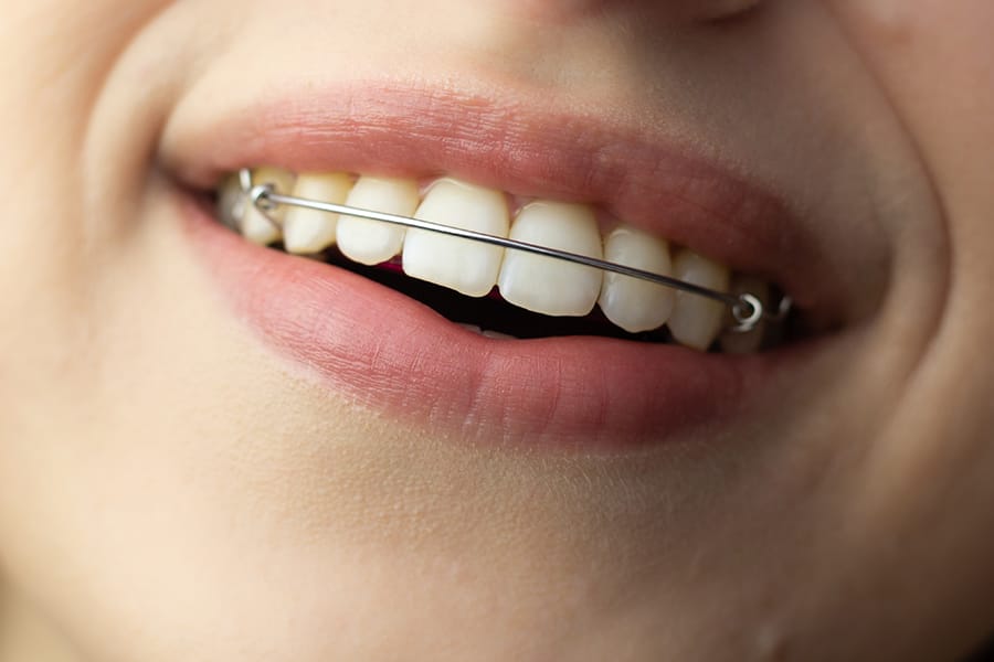 Appareil rétention amovible Pointe-Claire Ouest-de-l’île Montréal