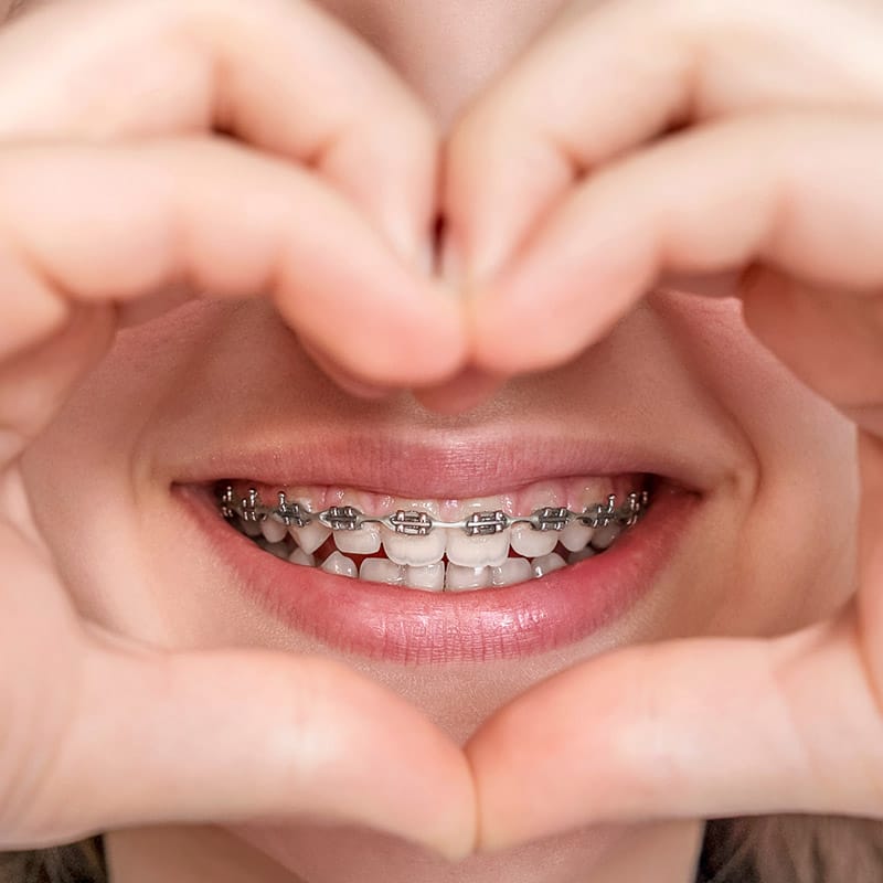 Broches métallique céramique Pointe-Claire Ouest-de-l’île Montréal