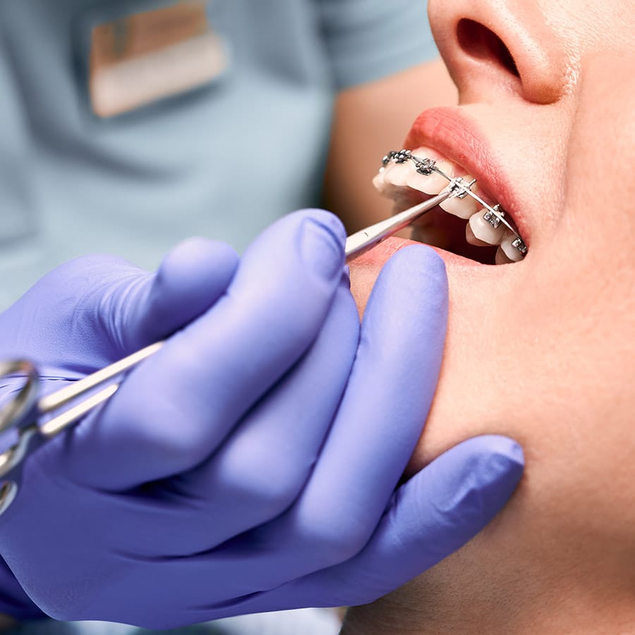 Broches métallique céramique Pointe-Claire Ouest-de-l’île Montréal